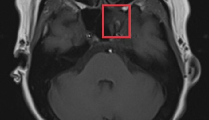 ผล MRI แสดงให้เห็นมวลสัญญาณผิดปกติในเยื่อบุโพรงจมูกด้านซ้ายและไซนัสสฟีนอยด์ด้านซ้าย ภาพ : โรงพยาบาลจัดให้