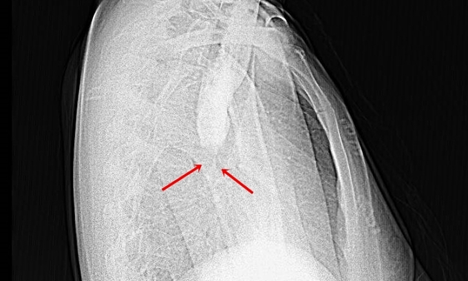 Radiographie d'une rétention de contraste oesophagien, spasme en position cardiaque. Photo : Hôpital fourni