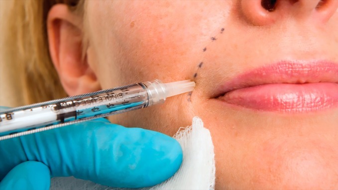 Tắc mạch do tiêm filler làm đẹp vùng mũi