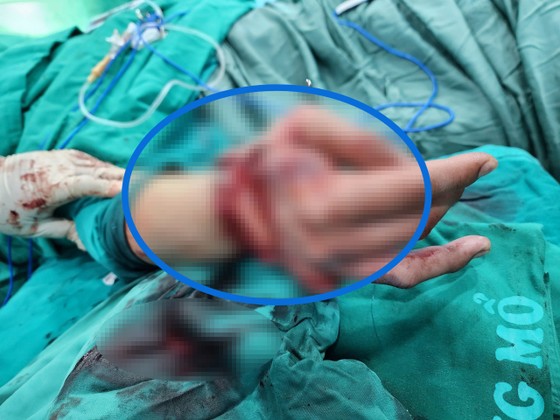 Doctor examining patient after microsurgery to reattach severed hand