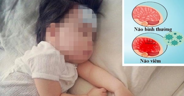 Anzeichen einer Meningitis bei Kindern