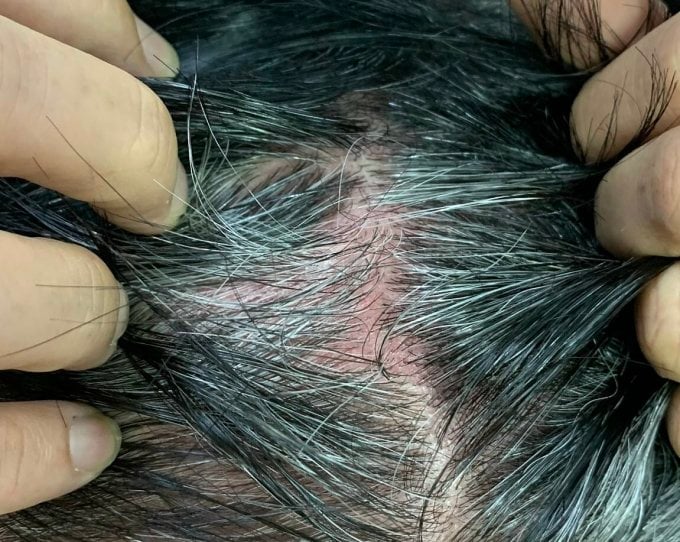 Mr. Nam's scalp was red, itchy and stinging after using the medicine to cover gray hair. Photo: Provided by the doctor