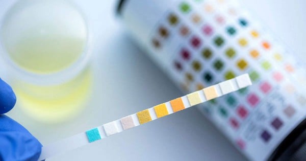 Que dit la couleur de votre urine sur votre santé ?