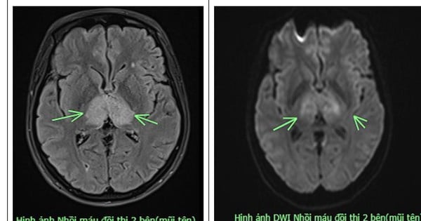 Đau đầu 4 ngày không đỡ, người phụ nữ 38 tuổi mắc bệnh nguy hiểm ở não