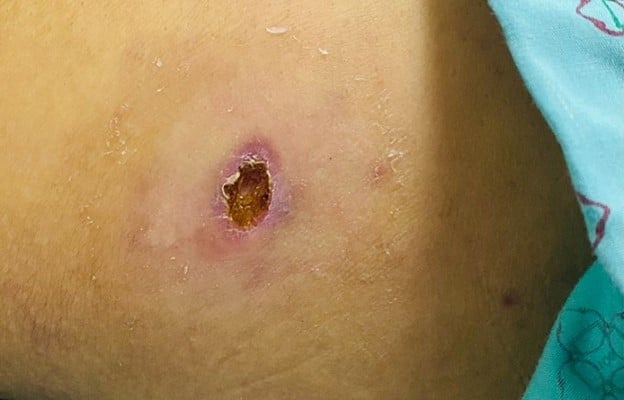 106 Menschen in Yen Bai haben Fieber, eine Person starb, weil sie zu spät ins Krankenhaus eingeliefert wurde. Bild 1