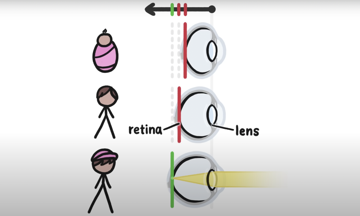 Why are children susceptible to myopia?