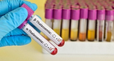 Chỉ số hồng cầu nhỏ báo hiệu bệnh Thalassemia