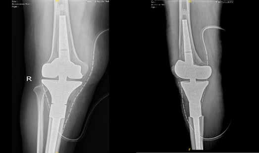 Chirurgie réussie pour une patiente atteinte d'un gliome non métastatique, image 1