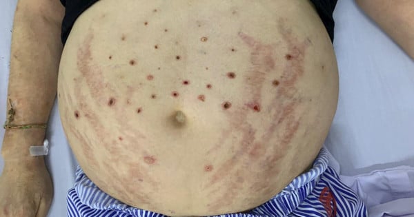 Hospitalizan a hombre en Hanoi tras ser picado por abejas para curar su enfermedad