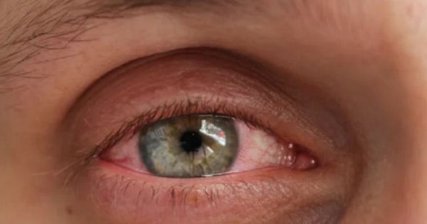 Can pink eye go away on its own?