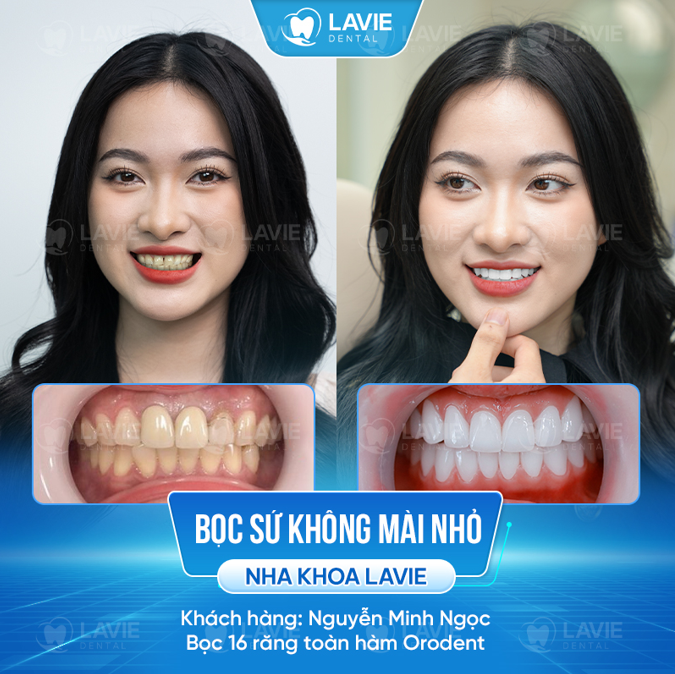 Kunde Minh Ngoc: Vorher und nachher mit Vollkeramikkronen bei Lavie Dental.