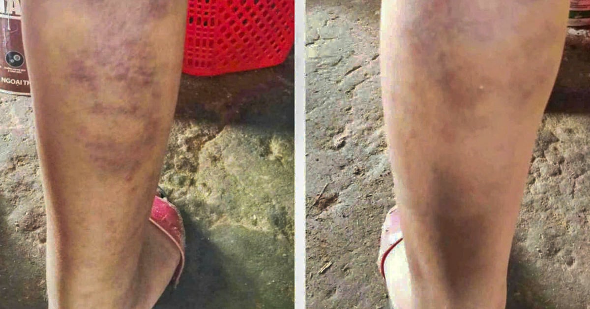 Teacher receives disciplinary warning for beating 6th grade student, leaving leg bruised