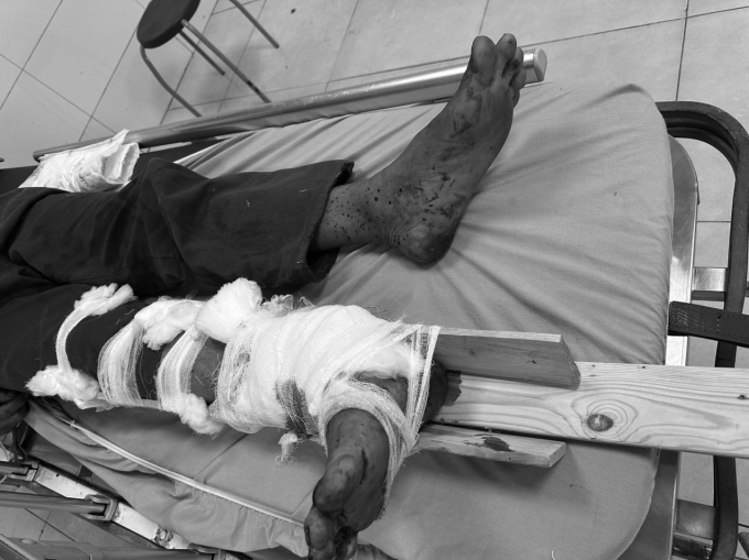 Se le administraron primeros auxilios a la pierna derecha del paciente y fue trasladado al Hospital General de Thanh Hoa. Foto: Proporcionada por el hospital.