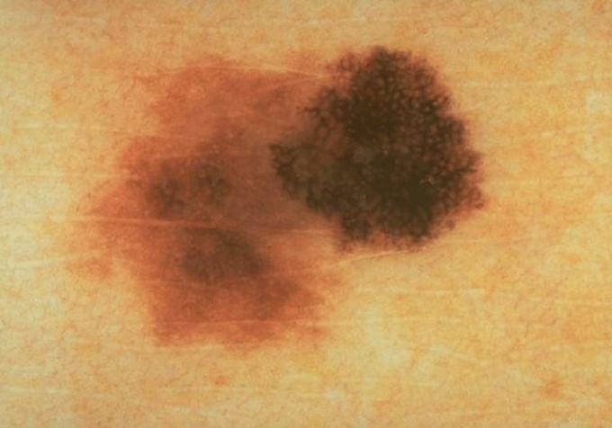 Imagen típica de un lunar asimétrico. Foto: Academia Americana de Dermatología