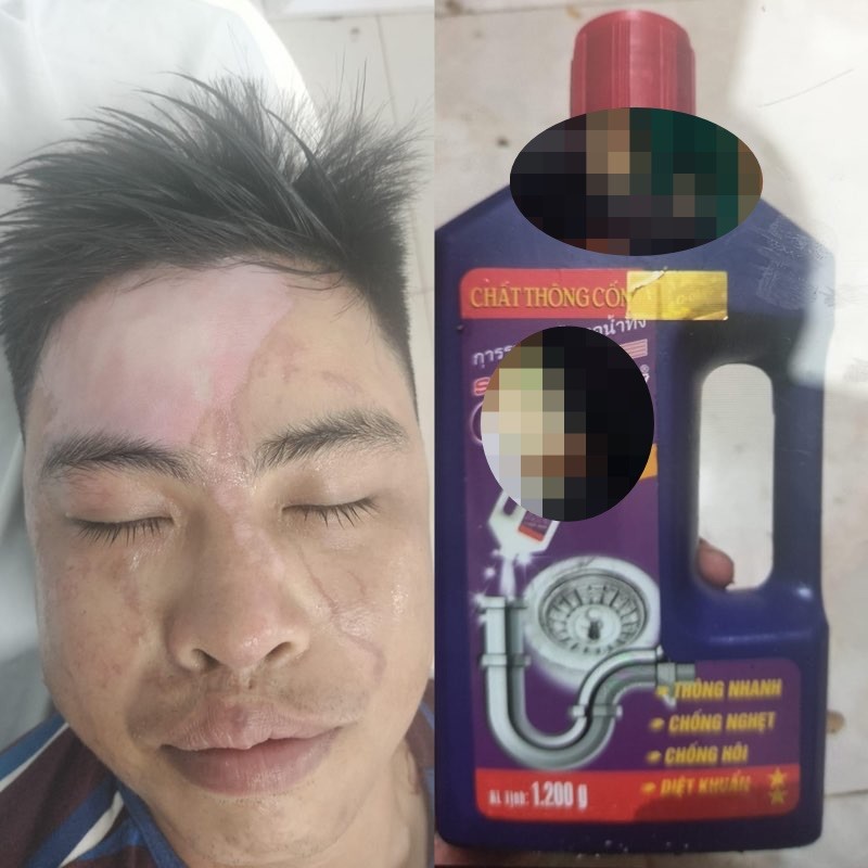 Many cases of blistering when using super speed drain cleaner picture 1