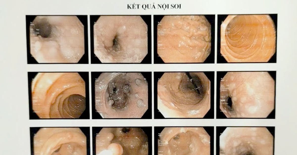 Hy hữu ca bệnh có u chi chít trong dạ dày và mọc khắp cơ thể