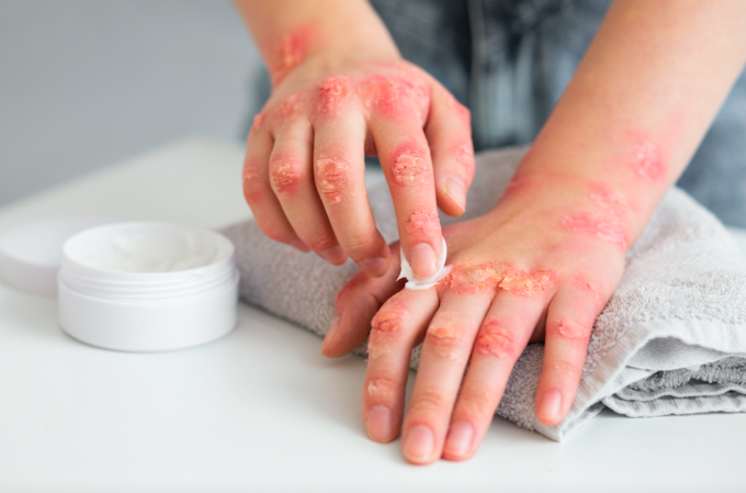 Ajuster votre mode de vie et vos habitudes peut aider à prévenir et à limiter les symptômes du psoriasis. Photo : Freepik