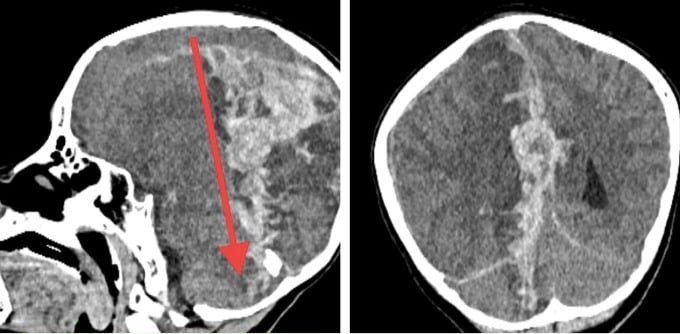 Imagen de la lesión en la tomografía computarizada. Foto: proporcionada por el hospital