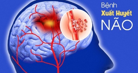 Recommended measures to prevent stroke and cerebral hemorrhage