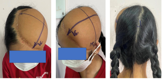 Images of patient's hair growing through treatment processes