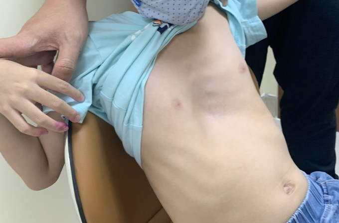 Kinder mit angeborener Trichterbrust, untersucht im Tam Anh Hospital, Ho-Chi-Minh-Stadt. Foto: Ha Vu