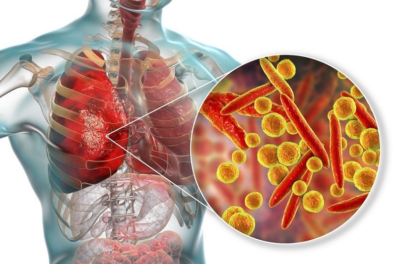 Immer mehr Kinder erkranken an Komplikationen einer durch Mycoplasma pneumoniae-Bakterien verursachten Lungenentzündung