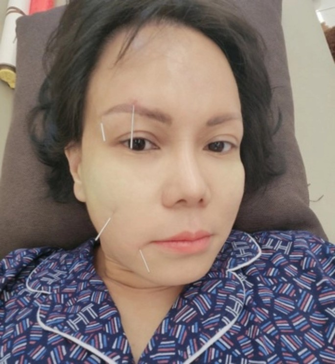 El artista Viet Huong debe someterse a acupuntura para tratar su enfermedad