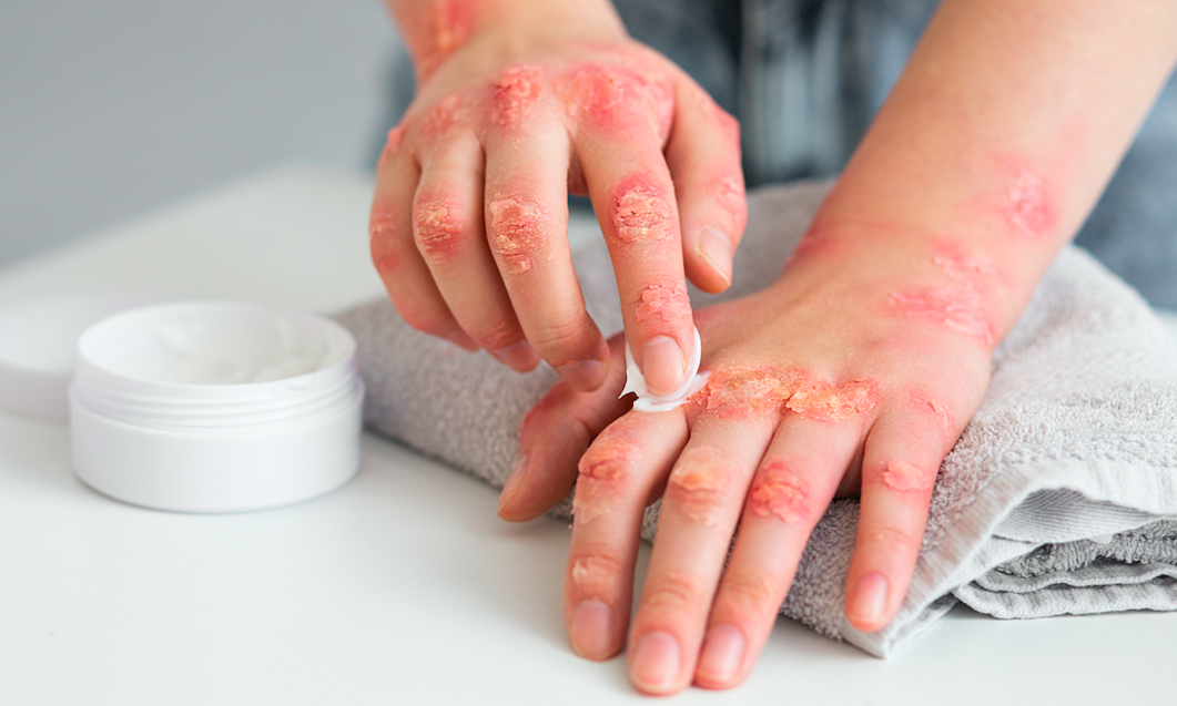 Habitudes courantes qui déclenchent le psoriasis