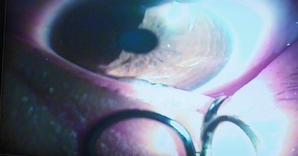 11 year old boy got fishhook stuck in eye while playing