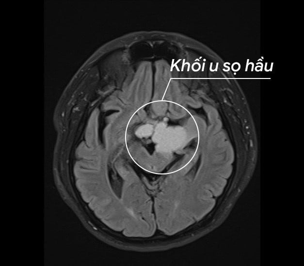 Rettung eines Mannes mit einem seltenen Kraniopharyngeom