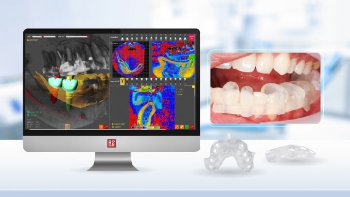 Trồng răng Implant công nghệ Safest giúp khách hàng không còn cảm giác lo lắng về chuyện sưng đau khi Implant và nhanh chóng có răng mới.