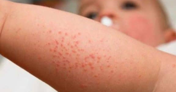 Measles shows signs of increasing during Tet, how to take care of children with measles at home?