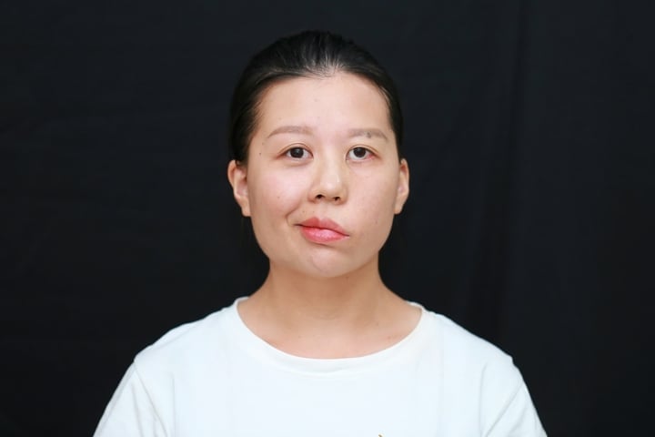 Trang is affected by the sequelae of facial nerve palsy, one side of her face is twisted and distorted. (Photo: NVCC)