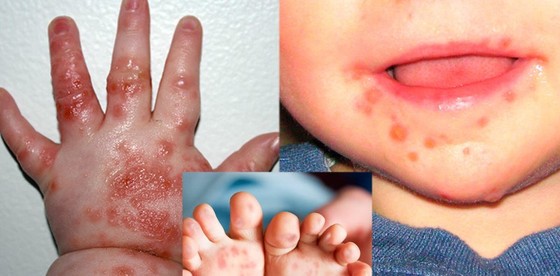 Ministry of Health urgently requests to minimize deaths due to hand, foot and mouth disease photo 2