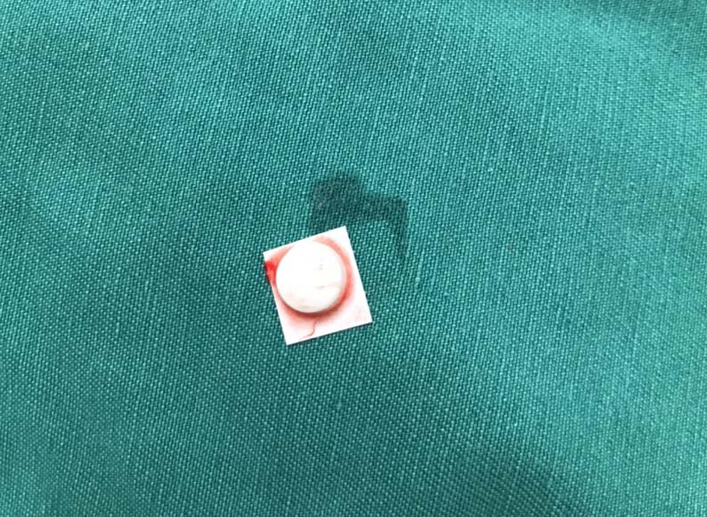 Krankenhausaufenthalt wegen Verschluckens von Tabletten und Plastiktüten Bild 1