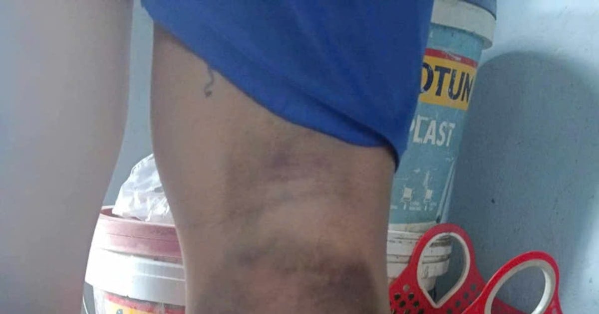 Warning for homeroom teacher who beat student, causing bruising on both legs