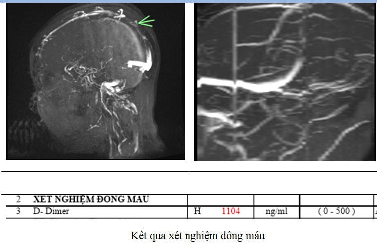 Đau đầu 4 ngày, đến viện mới phát hiện mắc thể đột quỵ não đặc biệt - Ảnh 1.