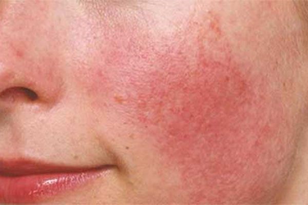 A woman suffered from swollen eyes due to using instant skin whitening cream on the internet photo 2