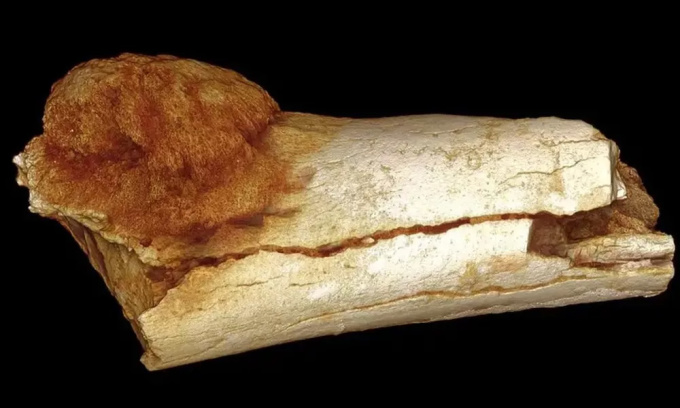 記録に残る最古の癌症例は170万年前、現生人類の近縁種である個体の足指骨に生じた腫瘍です。写真：パトリック・ランドルフ＝クイニー/UCLAN