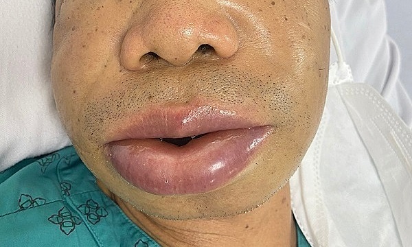 Hereditary angioedema