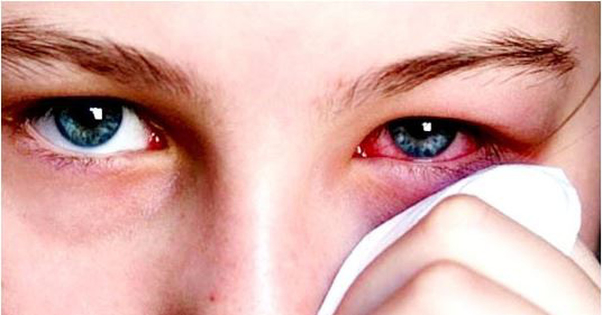 La enfermedad del ojo rosado puede convertirse en una epidemia después de una inundación: ¿cómo prevenirla?