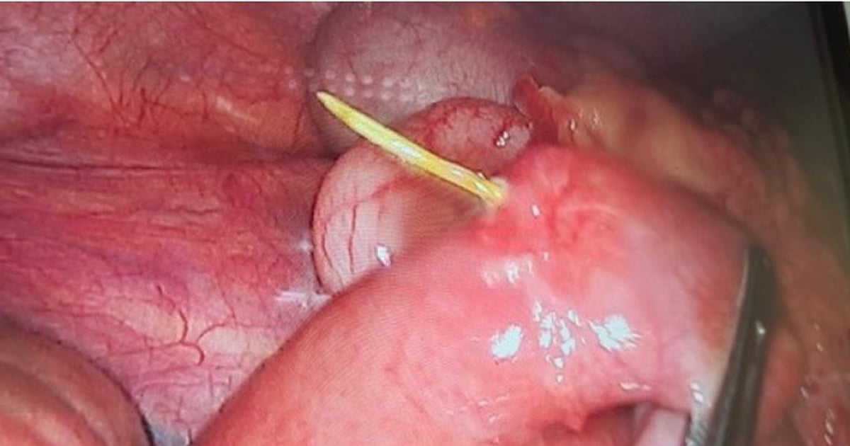 Young man swallows bamboo toothpick, leading to intestinal perforation