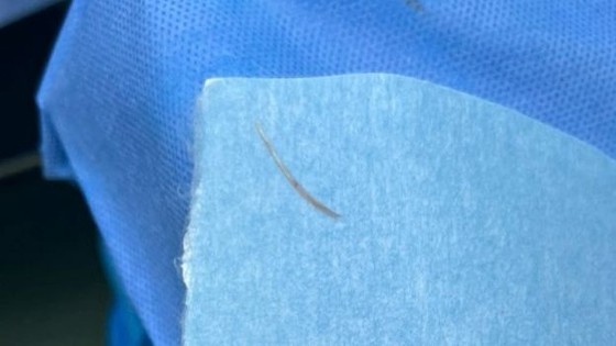 Una espina de pescado de 3,5 cm de largo atravesó los intestinos y entró en el abdomen del paciente.