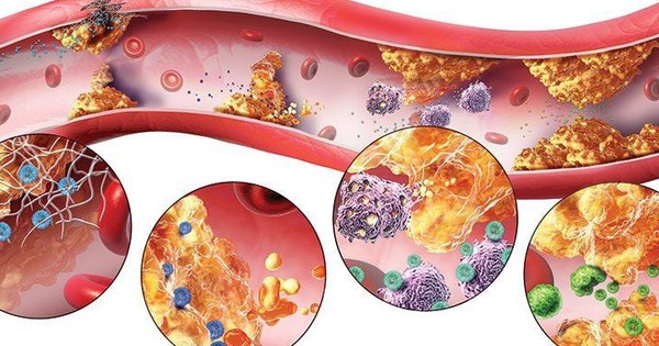 43-year-old man in Phu Tho discovered his blood fat was 40 times higher, Vietnamese people need to do this to prevent disease