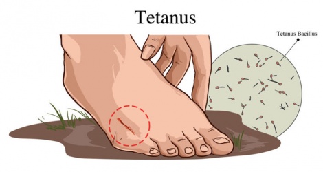 Tetanus due to being subjective with small wounds