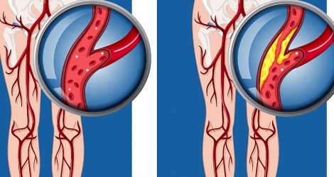 Biến chứng của bệnh lý động mạch