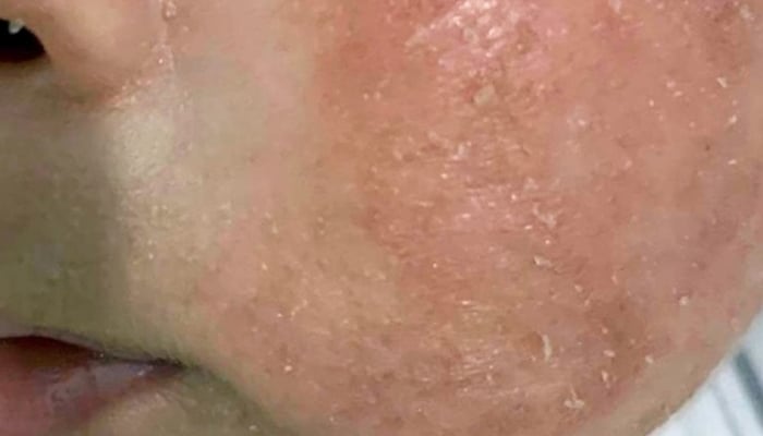 Complicaciones graves de la dermatitis atópica hereditaria en niños