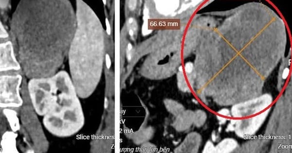 口の中が苦い、脇腹が痛い、検査でまれに大きな腫瘍が発見される