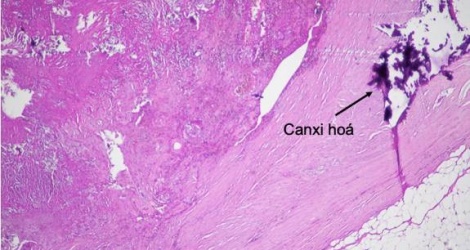 Bệnh nhân bị bỏ quên gạc trong bụng 14 năm sau phẫu thuật