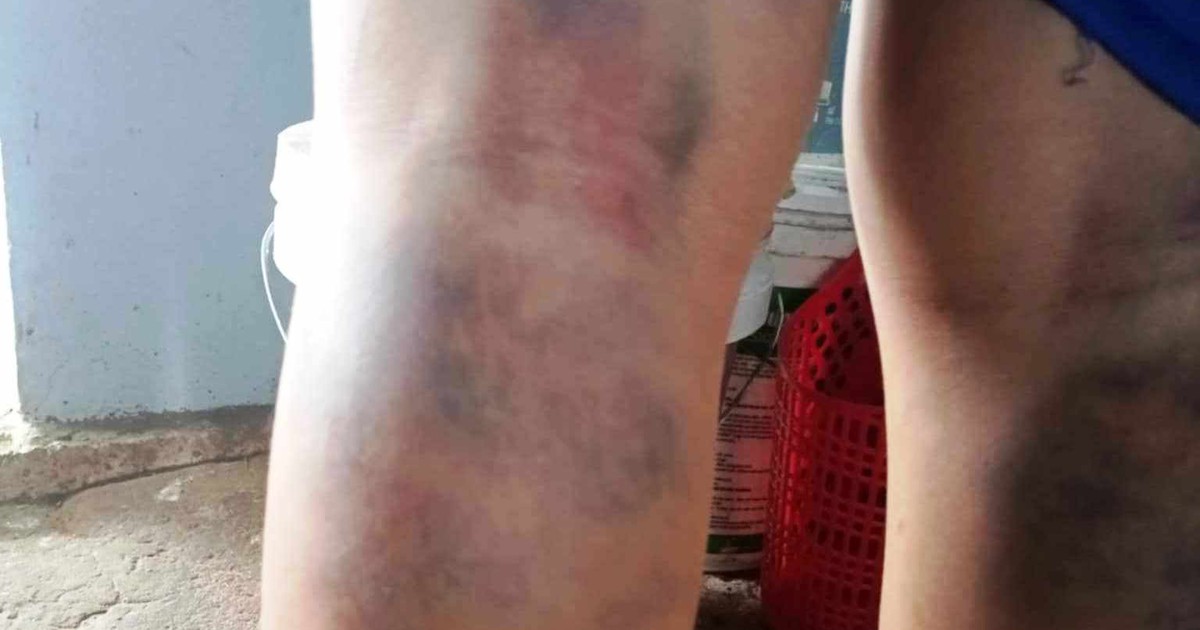 Warning to homeroom teacher who beat student, causing bruising on both legs